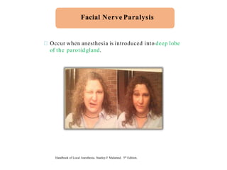 Occur when anesthesia is introduced into deep lobe
of the parotidgland.
Facial Nerve Paralysis
Handbook of Local Anesthesia. Stanley F Malamed. 5th Edition.
 