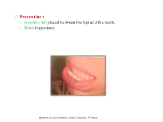 Prevention :
◦ A cotton roll placed between the lips and the teeth.
◦ Warn the patient.
Handbook of Local Anesthesia. Stanley F Malamed. 5th Edition.
 