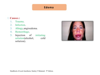 Causes :
1. Trauma.
2. Infection.
3. Allergy, angioedema.
4. Hemorrhage.
5. Injection of irritating
solution(alcohol, cold
solution).
Edema
Handbook of Local Anesthesia. Stanley F Malamed. 5th Edition.
 