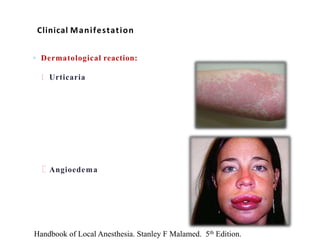◦ Dermatological reaction:
Urticaria
Angioedema
Clinical Manifestation
Handbook of Local Anesthesia. Stanley F Malamed. 5th Edition.
 