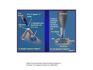 Newer Local Anaesthetic Drugs and Delivery Systems in
Dentistry – An Update by sharma et al JDMS,2012
 