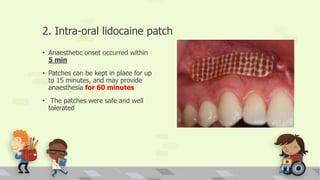 2. Intra-oral lidocaine patch
• Anaesthetic onset occurred within
5 min
• Patches can be kept in place for up
to 15 minutes, and may provide
anaesthesia for 60 minutes
• The patches were safe and well
tolerated
 