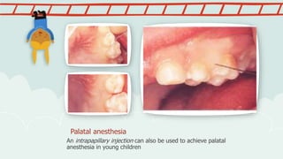 Palatal anesthesia
An intrapapillary injection can also be used to achieve palatal
anesthesia in young children
 