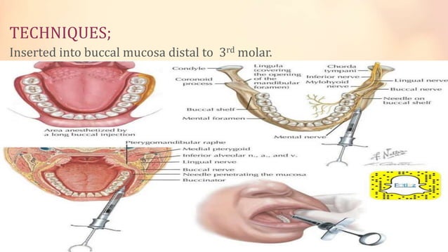 LOCAL ANESTHESIA TECHNIQUE.pptx | Ear, Nose and Throat Conditions ...