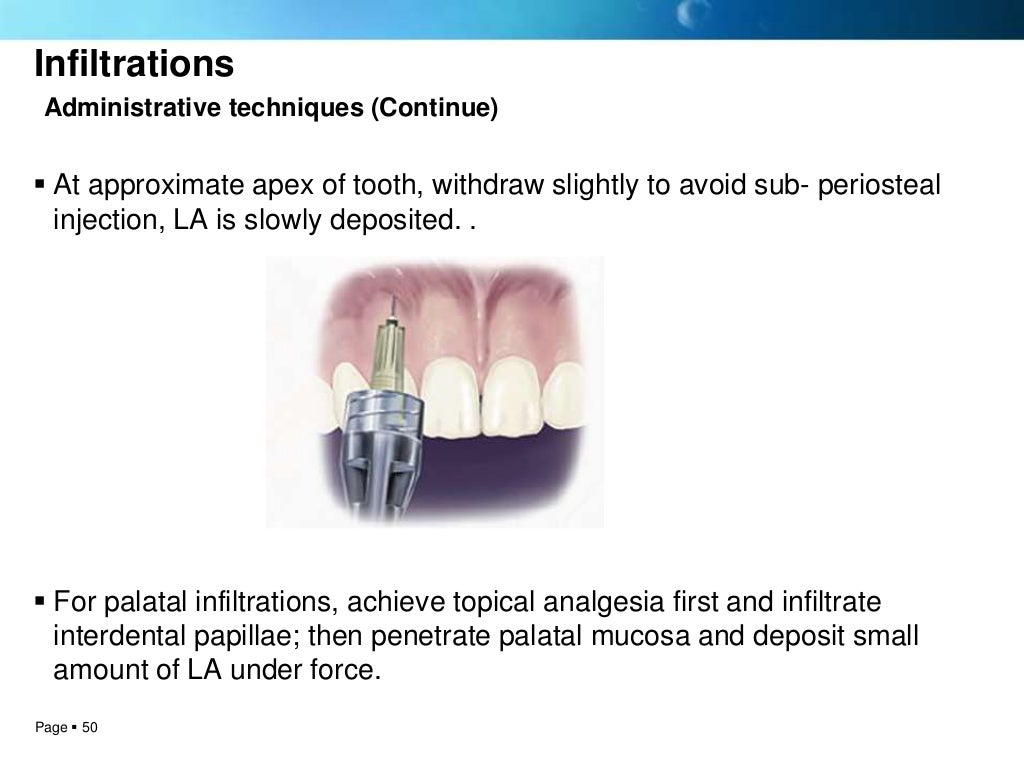 Local anesthesia techniques