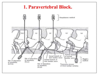 1. Paravertebral Block.
 