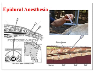 Epidural Anesthesia
 