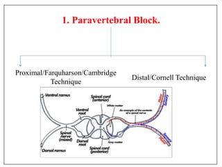 1. Paravertebral Block.
Proximal/Farquharson/Cambridge
Technique
Distal/Cornell Technique
 