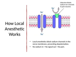 How Local Anesthesia Works Understanding How Local Anesthetics Work in Dental Hygiene Practice | PPTX