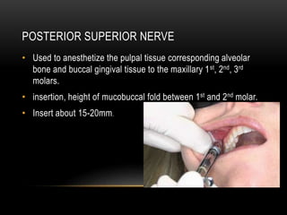 POSTERIOR SUPERIOR NERVE
• Used to anesthetize the pulpal tissue corresponding alveolar
bone and buccal gingival tissue to...