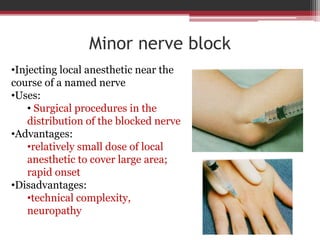 Minor nerve block
•Injecting local anesthetic near the
course of a named nerve
•Uses:
• Surgical procedures in the
distribution of the blocked nerve
•Advantages:
•relatively small dose of local
anesthetic to cover large area;
rapid onset
•Disadvantages:
•technical complexity,
neuropathy

 