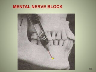 MENTAL NERVE BLOCK
100
 