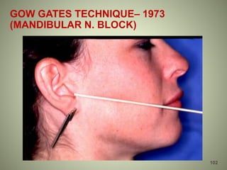 GOW GATES TECHNIQUE– 1973
(MANDIBULAR N. BLOCK)
102
 