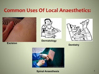 4
Common Uses Of Local Anaesthetics:
Dentistry
Excision
Dermatology
Spinal Anaesthesia
 