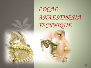 LOCAL
ANAESTHESIA
TECHNIQUE
66
 