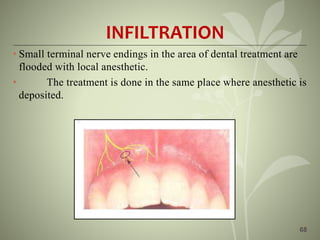 68
INFILTRATION
• Small terminal nerve endings in the area of dental treatment are
flooded with local anesthetic.
• The treatment is done in the same place where anesthetic is
deposited.
 