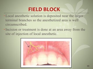 69
FIELD BLOCK
•Local anesthetic solution is deposited near the larger
terminal branches so the anesthetized area is well
circumscribed.
•Incision or treatment is done at an area away from the
site of injection of local anesthetic.
 