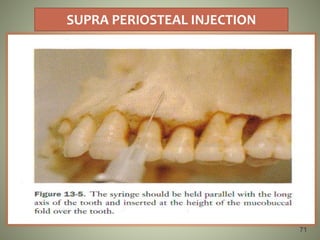 SUPRA PERIOSTEAL INJECTION
71
 
