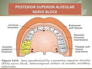 POSTERIOR SUPERIOR ALVEOLAR
NERVE BLOCK
72
 