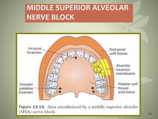 75
MIDDLE SUPERIOR ALVEOLAR
NERVE BLOCK
 