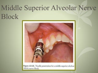 Middle Superior Alveolar Nerve
Block
 