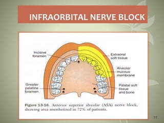 INFRAORBITAL NERVE BLOCK
77
 