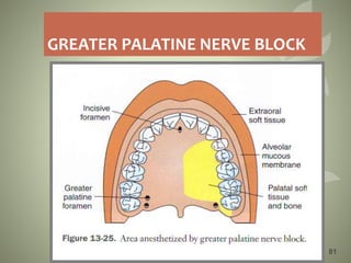 GREATER PALATINE NERVE BLOCK
81
 