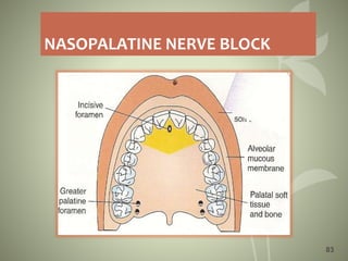NASOPALATINE NERVE BLOCK
83
 