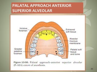 85
PALATAL APPROACH ANTERIOR
SUPERIOR ALVEOLAR
 
