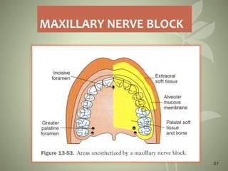 87
MAXILLARY NERVE BLOCK
 