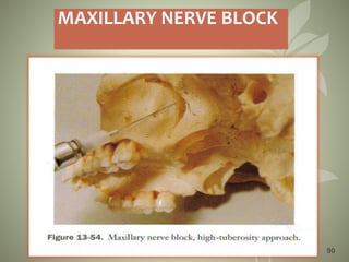 90
MAXILLARY NERVE BLOCK
 