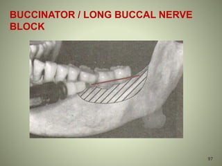 BUCCINATOR / LONG BUCCAL NERVE
BLOCK
97
 