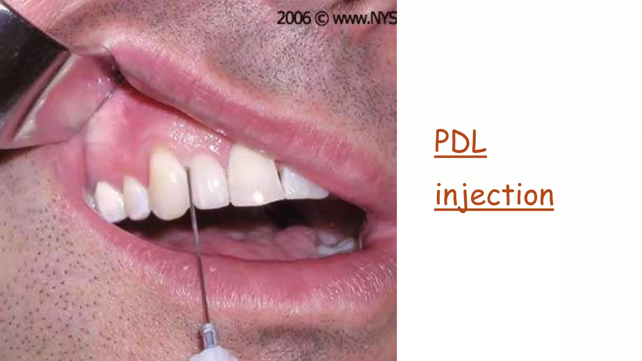 PDL
injection
 
