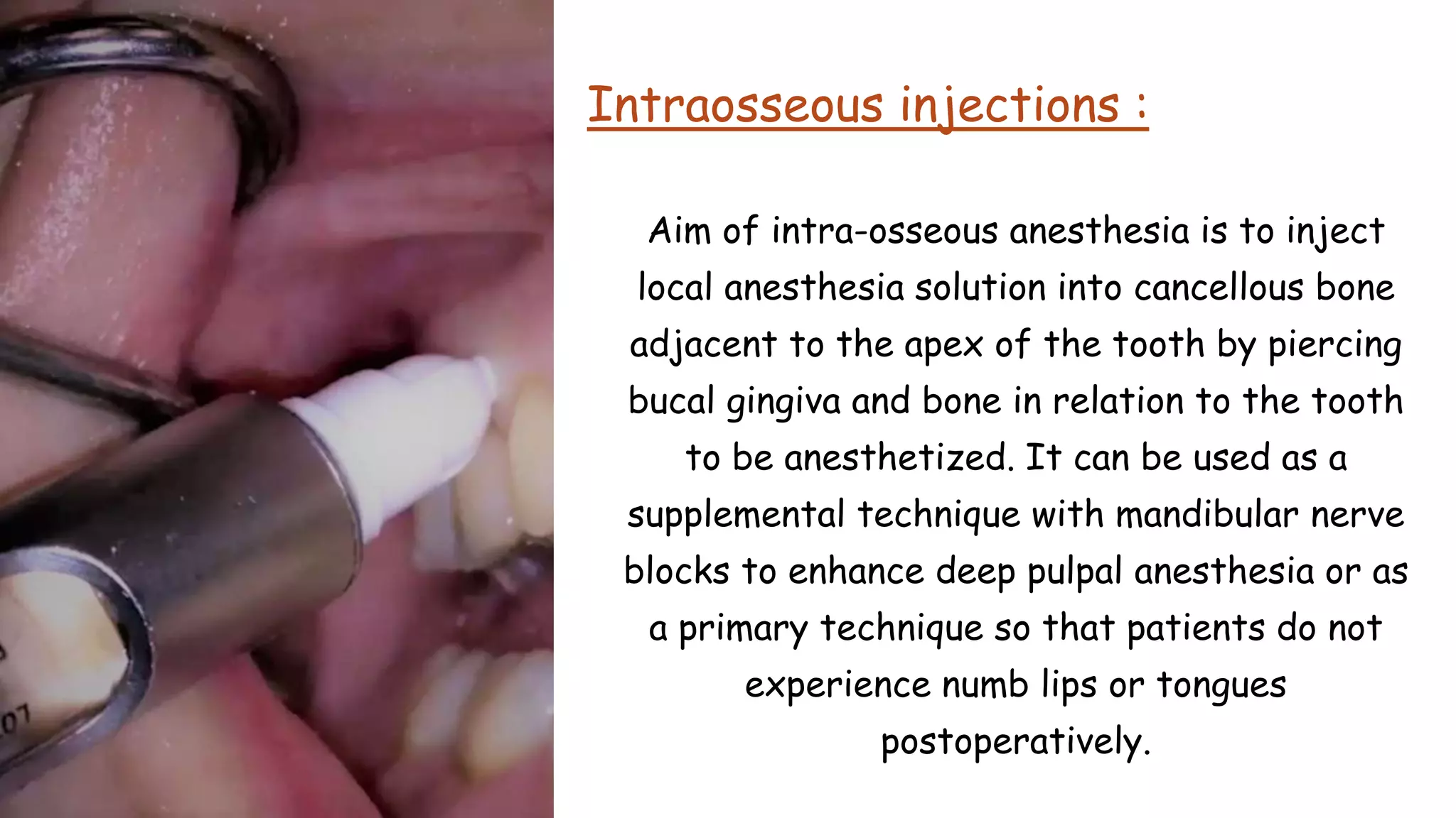 Intraosseous injections :
Aim of intra-osseous anesthesia is to inject
local anesthesia solution into cancellous bone
adjacent to the apex of the tooth by piercing
bucal gingiva and bone in relation to the tooth
to be anesthetized. It can be used as a
supplemental technique with mandibular nerve
blocks to enhance deep pulpal anesthesia or as
a primary technique so that patients do not
experience numb lips or tongues
postoperatively.
 