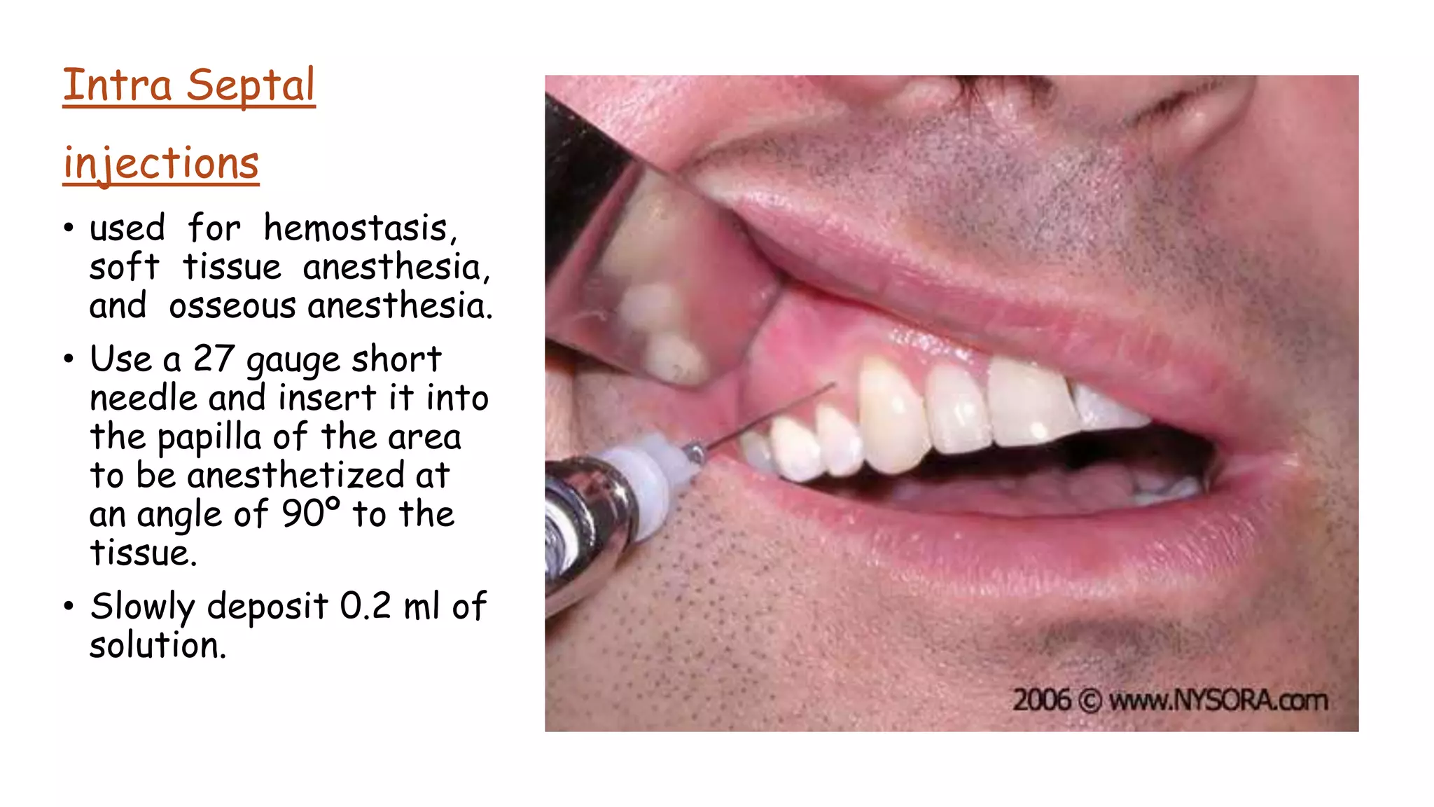 Intra Septal
injections
• used for hemostasis,
soft tissue anesthesia,
and osseous anesthesia.
• Use a 27 gauge short
needle and insert it into
the papilla of the area
to be anesthetized at
an angle of 90º to the
tissue.
• Slowly deposit 0.2 ml of
solution.
 