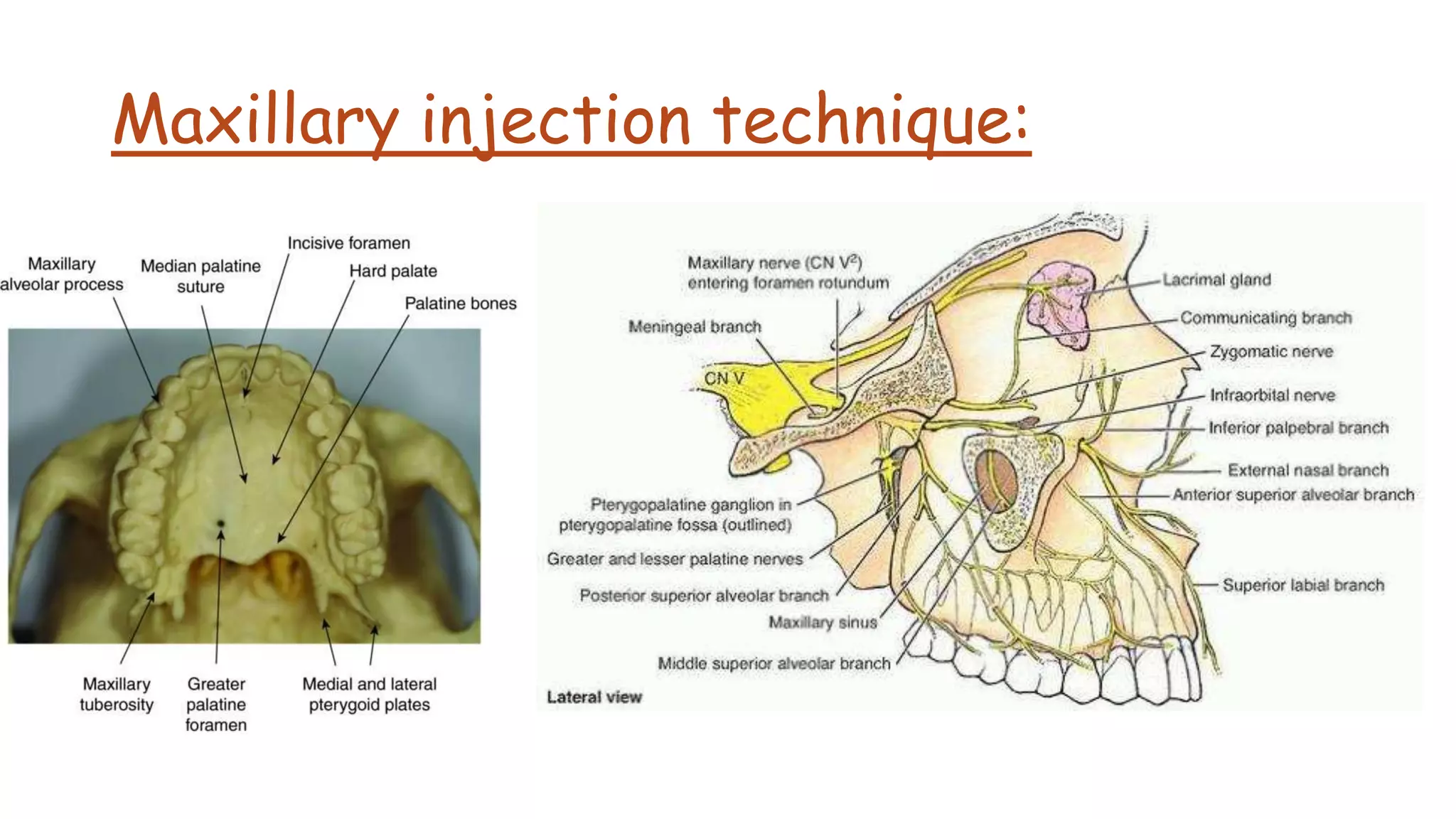Maxillary injection technique:
 