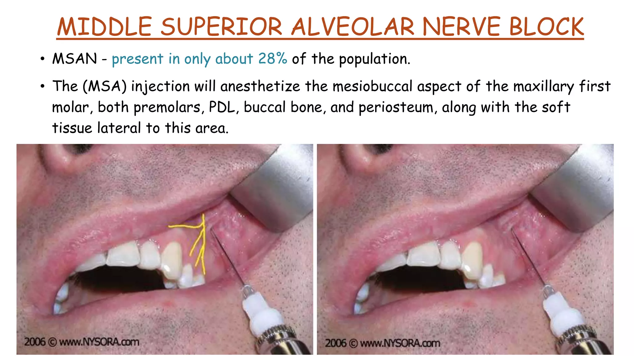 MIDDLE SUPERIOR ALVEOLAR NERVE BLOCK
• MSAN - present in only about 28% of the population.
• The (MSA) injection will anesthetize the mesiobuccal aspect of the maxillary first
molar, both premolars, PDL, buccal bone, and periosteum, along with the soft
tissue lateral to this area.
 