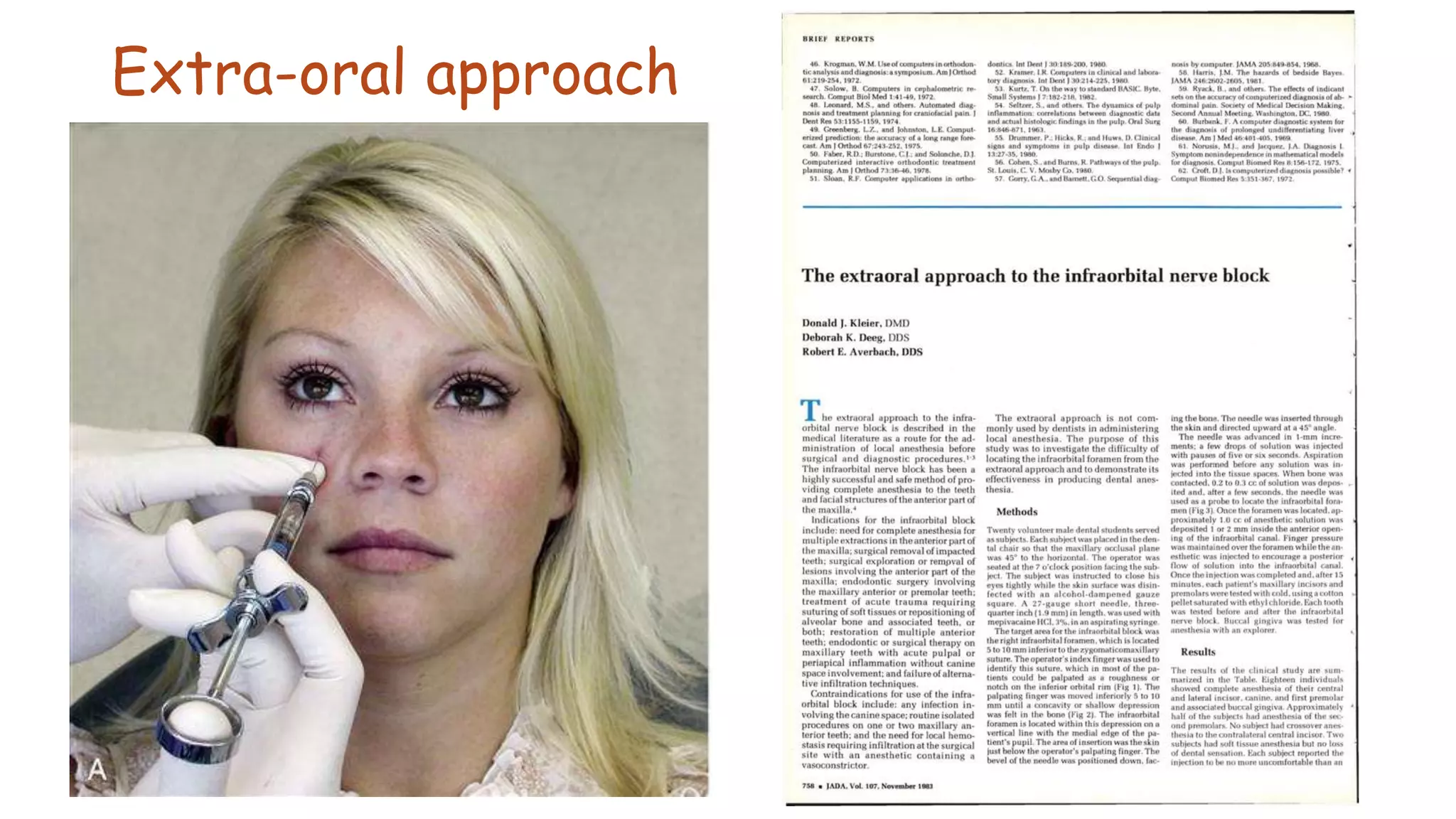 Extra-oral approach
 