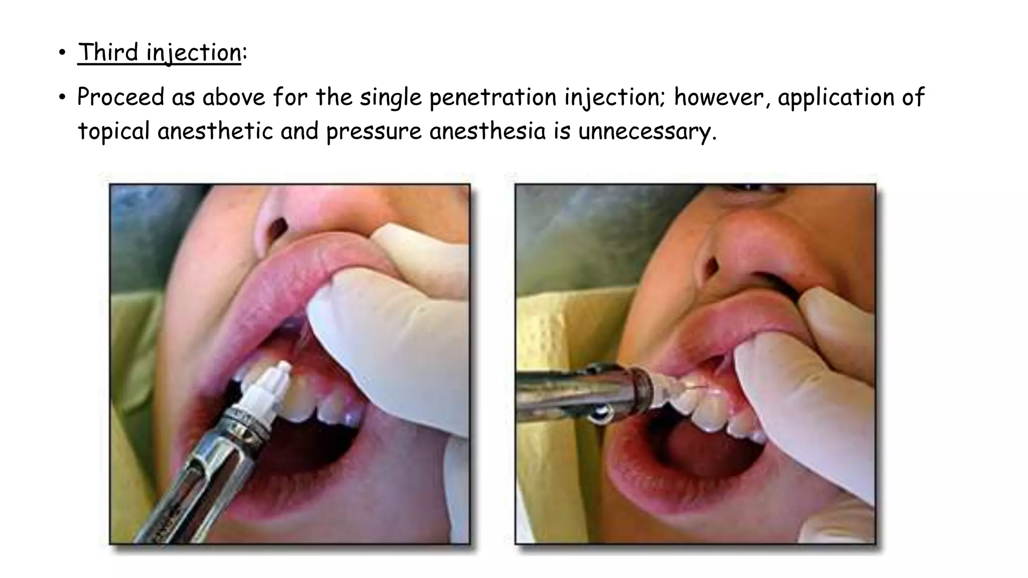• Third injection:
• Proceed as above for the single penetration injection; however, application of
topical anesthetic and pressure anesthesia is unnecessary.
 