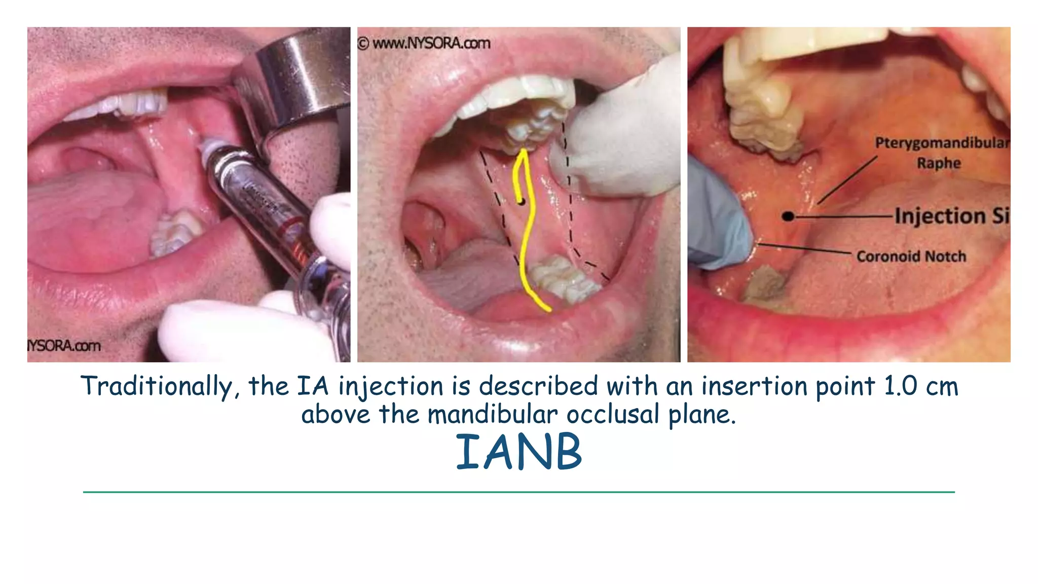 Traditionally, the IA injection is described with an insertion point 1.0 cm
above the mandibular occlusal plane.
IANB
 