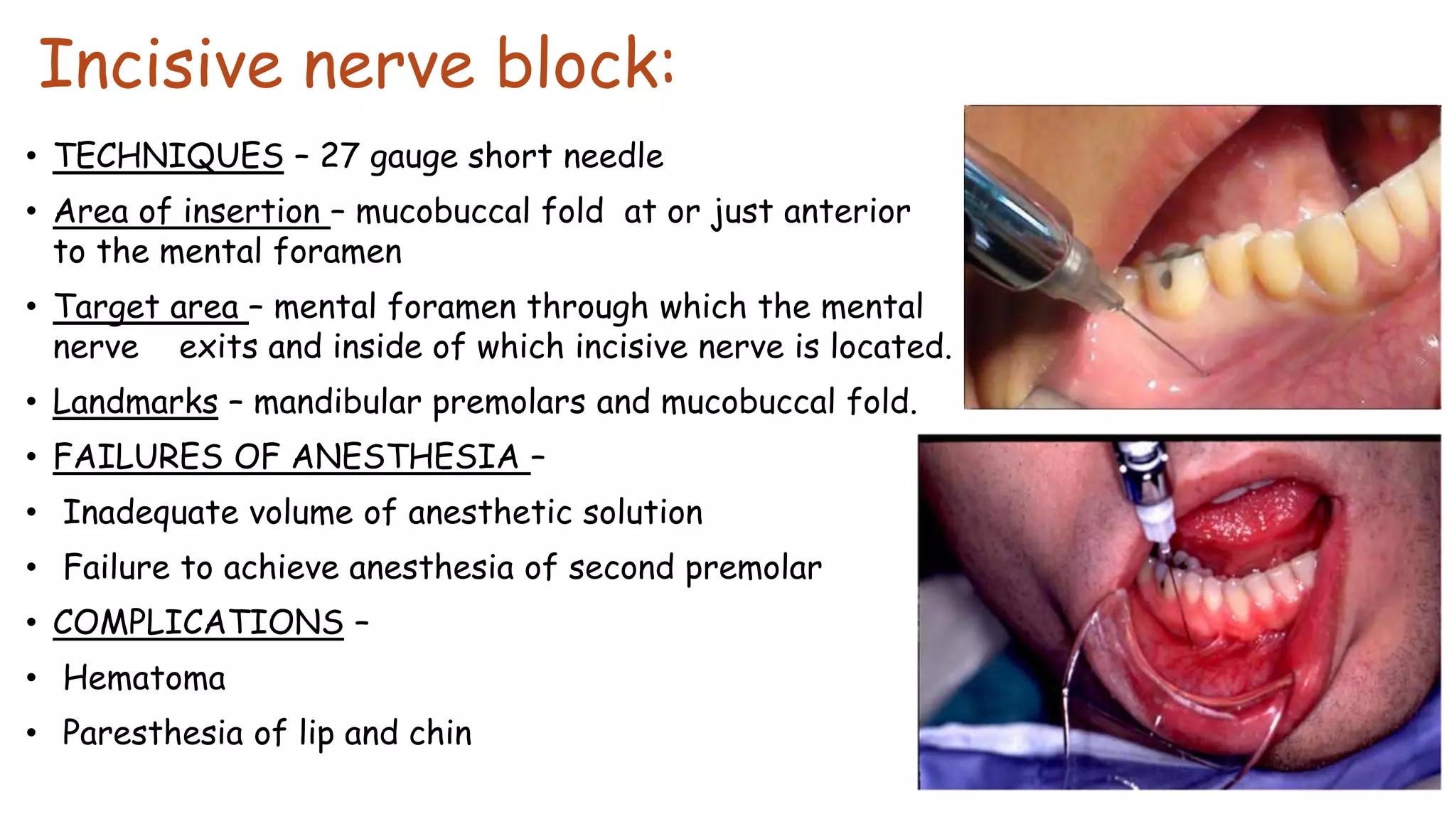 Incisive nerve block:
• TECHNIQUES – 27 gauge short needle
• Area of insertion – mucobuccal fold at or just anterior
to the mental foramen
• Target area – mental foramen through which the mental
nerve exits and inside of which incisive nerve is located.
• Landmarks – mandibular premolars and mucobuccal fold.
• FAILURES OF ANESTHESIA –
• Inadequate volume of anesthetic solution
• Failure to achieve anesthesia of second premolar
• COMPLICATIONS –
• Hematoma
• Paresthesia of lip and chin
 