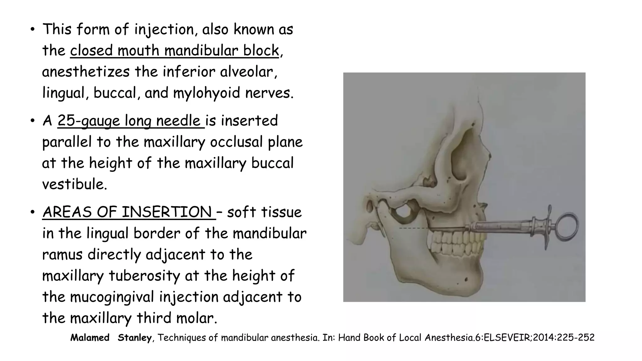 Malamed Stanley, Techniques of mandibular anesthesia. In: Hand Book of Local Anesthesia.6:ELSEVEIR;2014:225-252
• This form of injection, also known as
the closed mouth mandibular block,
anesthetizes the inferior alveolar,
lingual, buccal, and mylohyoid nerves.
• A 25-gauge long needle is inserted
parallel to the maxillary occlusal plane
at the height of the maxillary buccal
vestibule.
• AREAS OF INSERTION – soft tissue
in the lingual border of the mandibular
ramus directly adjacent to the
maxillary tuberosity at the height of
the mucogingival injection adjacent to
the maxillary third molar.
 