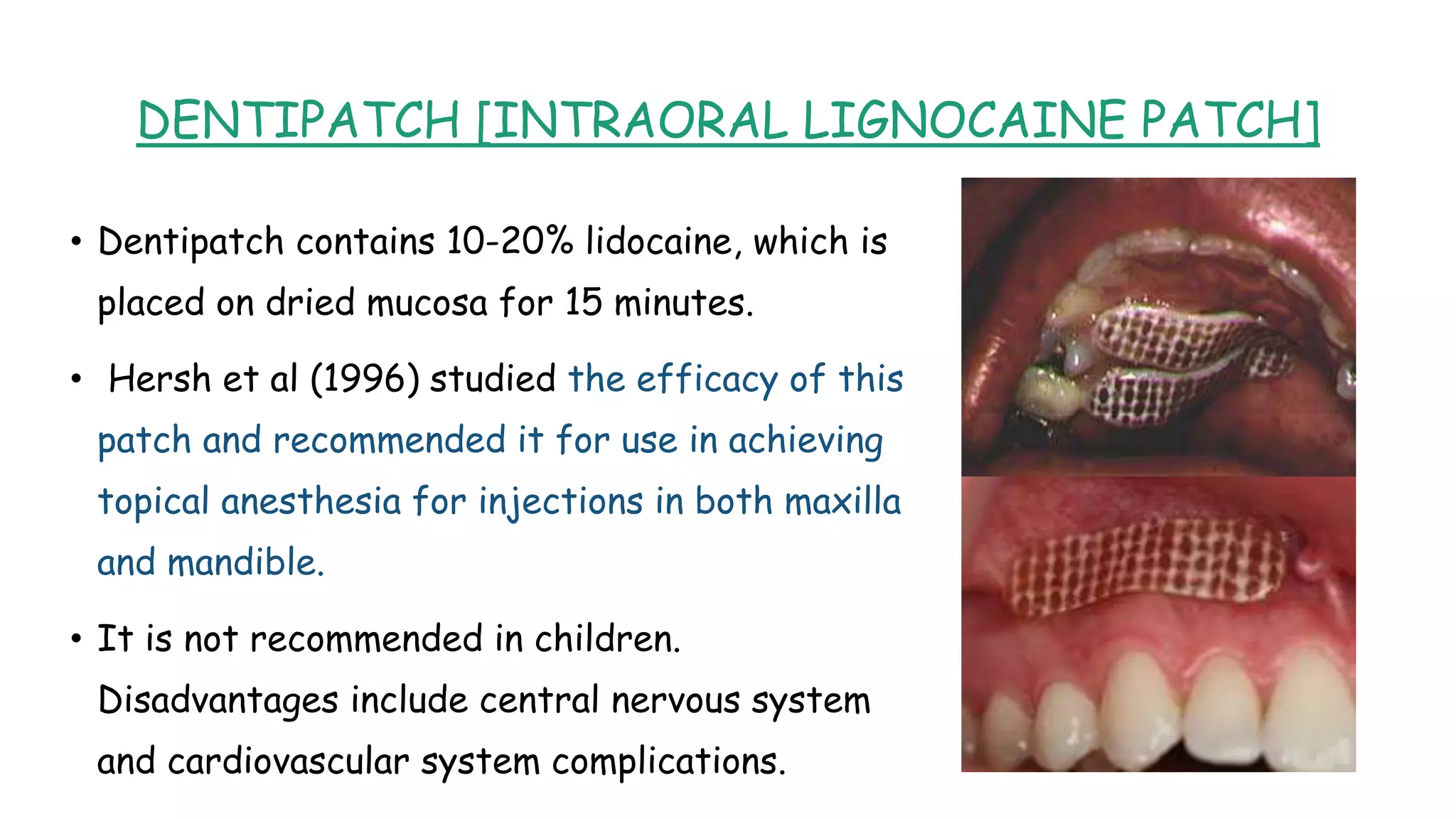 DENTIPATCH [INTRAORAL LIGNOCAINE PATCH]
• Dentipatch contains 10-20% lidocaine, which is
placed on dried mucosa for 15 minutes.
• Hersh et al (1996) studied the efficacy of this
patch and recommended it for use in achieving
topical anesthesia for injections in both maxilla
and mandible.
• It is not recommended in children.
Disadvantages include central nervous system
and cardiovascular system complications.
 