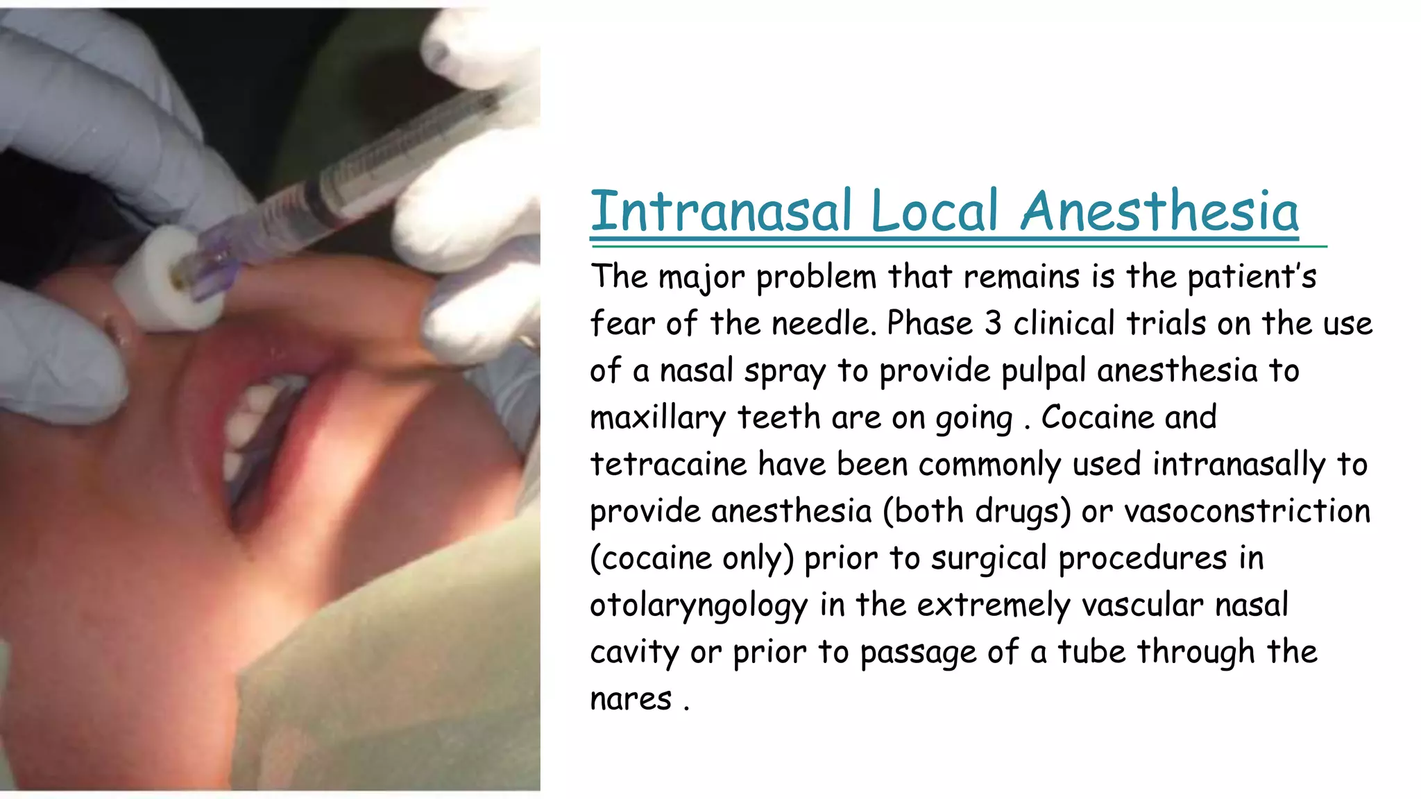 Intranasal Local Anesthesia
The major problem that remains is the patient’s
fear of the needle. Phase 3 clinical trials on the use
of a nasal spray to provide pulpal anesthesia to
maxillary teeth are on going . Cocaine and
tetracaine have been commonly used intranasally to
provide anesthesia (both drugs) or vasoconstriction
(cocaine only) prior to surgical procedures in
otolaryngology in the extremely vascular nasal
cavity or prior to passage of a tube through the
nares .
 