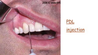 Local anesthetic techniques | PPTX