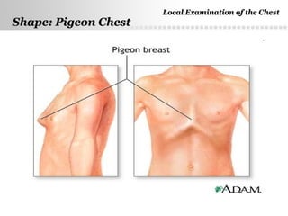 Page  10
Shape: Pigeon ChestShape: Pigeon Chest
Local Examination of the ChestLocal Examination of the Chest
 
