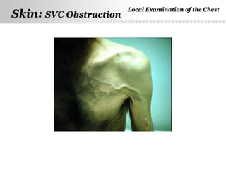 Page  15
Skin:Skin: SVC ObstructionSVC Obstruction
Local Examination of the ChestLocal Examination of the Chest
 