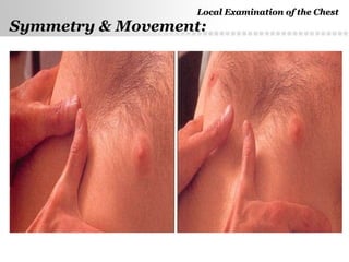 Page  19
Symmetry & Movement:
Local Examination of the ChestLocal Examination of the Chest
 