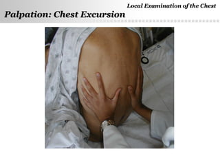Page  20
Palpation: Chest ExcursionPalpation: Chest Excursion
Local Examination of the ChestLocal Examination of the Chest
 