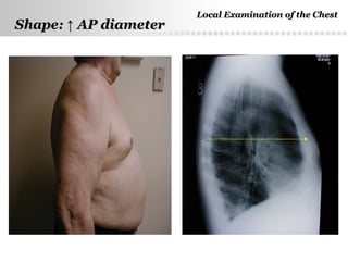 Page  5
Shape:Shape: ↑↑ AP diameterAP diameter
Local Examination of the ChestLocal Examination of the Chest
 